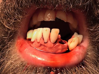 Выпадающие зубы