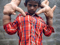 Мальчик с самыми большими в мире руками